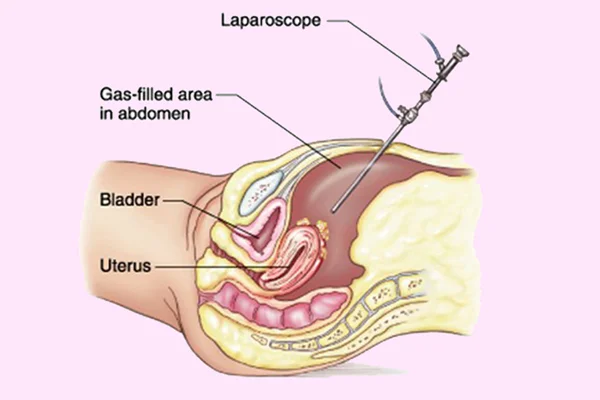 Hysteroscopy